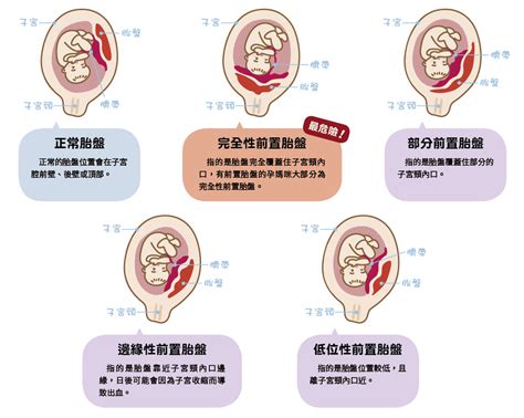 前置胎盤 症狀|認識「前置胎盤」4種型態及主要症狀｜Mombaby 媽 